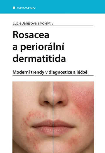 Rosacea a periorální dermatitida - Moderní trendy v diagnostice a léčbě